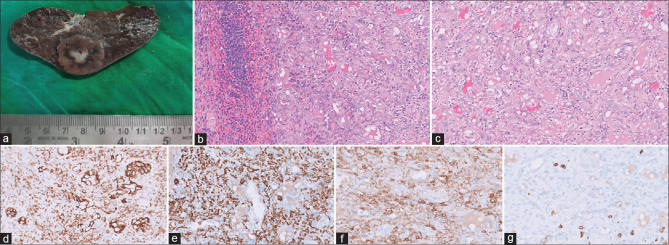 Splenic surprise in a case of renal cell carcinoma: Unusual case or association?