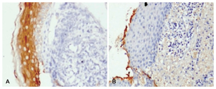 Immunohistochemical Analysis of the Expression of Cytokeratins in Acquired Cholesteatoma and Its Clinico-Radiological Correlation.