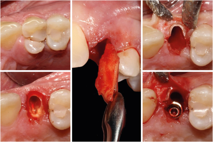 The socket shield technique and its complications, implant survival rate, and clinical outcomes: a systematic review.