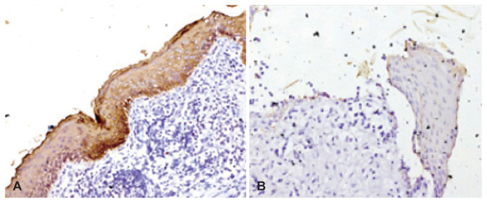 Immunohistochemical Analysis of the Expression of Cytokeratins in Acquired Cholesteatoma and Its Clinico-Radiological Correlation.