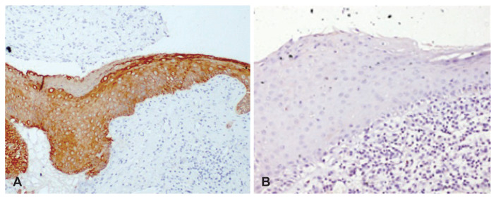 Immunohistochemical Analysis of the Expression of Cytokeratins in Acquired Cholesteatoma and Its Clinico-Radiological Correlation.