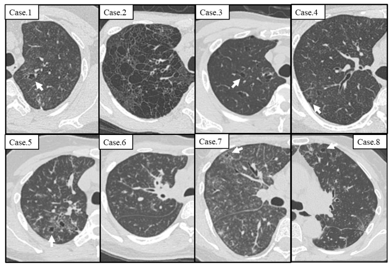 Radiological and Pathological Features of Cyst Formation in Idiopathic Multicentric Castleman Disease.