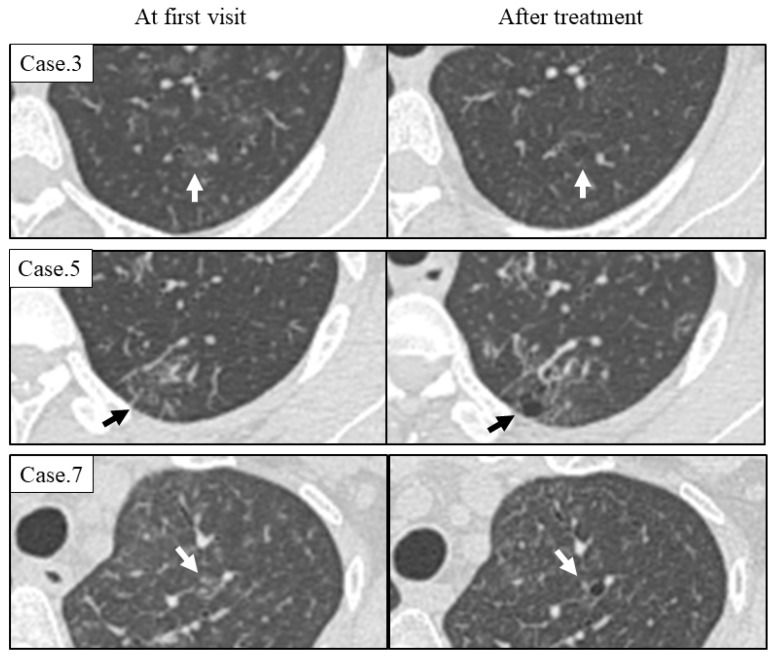 Radiological and Pathological Features of Cyst Formation in Idiopathic Multicentric Castleman Disease.