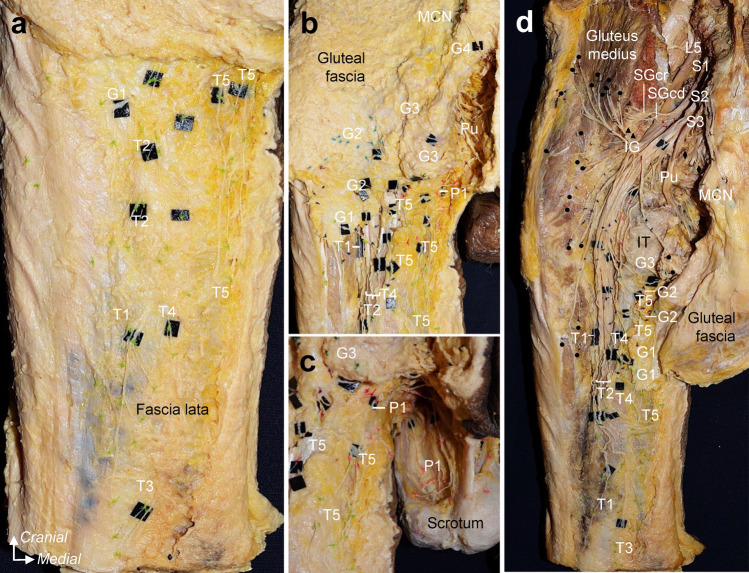 Origin, course, and distribution of the posterior femoral cutaneous nerve and the spatial relationship among its branches