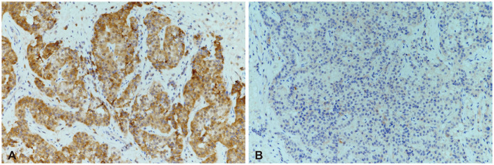 Pituitary Apoplexy After Leuprolide Therapy in a Breast Cancer Patient: A Case Report.