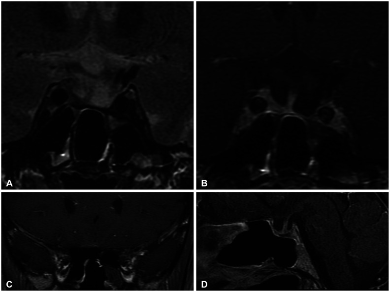 Pituitary Apoplexy After Leuprolide Therapy in a Breast Cancer Patient: A Case Report.