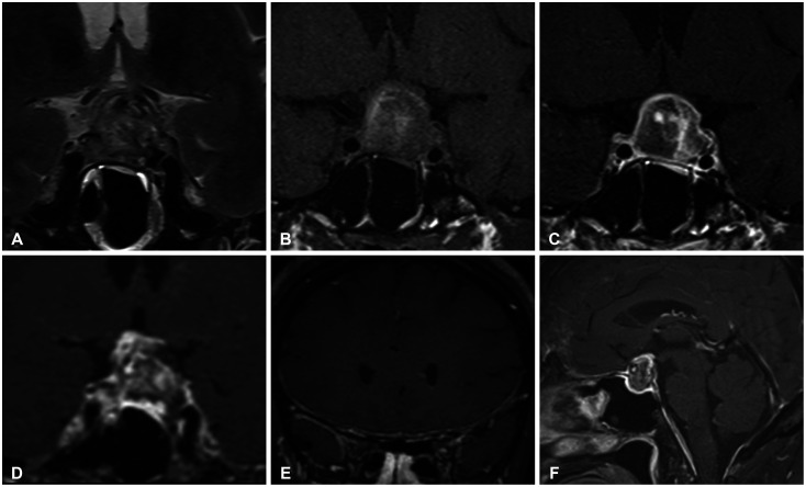 Pituitary Apoplexy After Leuprolide Therapy in a Breast Cancer Patient: A Case Report.