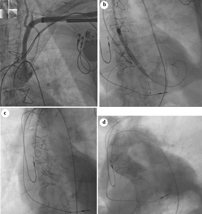 Left Axillary Access for Transcatheter Aortic Valve Implantation in a Patient With Two Dependent Internal Mammary Artery Grafts and a Permanent Left-Sided Implanted Pacemaker.