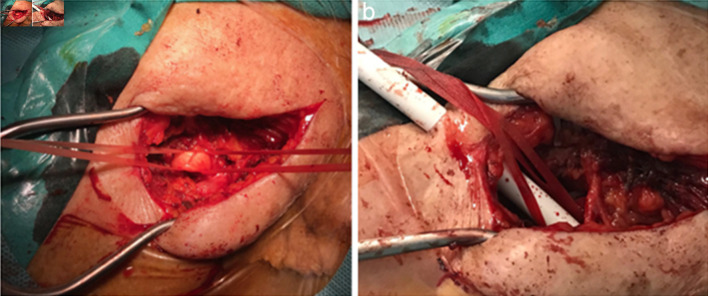 Left Axillary Access for Transcatheter Aortic Valve Implantation in a Patient With Two Dependent Internal Mammary Artery Grafts and a Permanent Left-Sided Implanted Pacemaker.