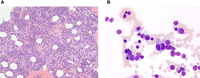 A familial <i>SAMD9</i> variant present in pediatric myelodysplastic syndrome.