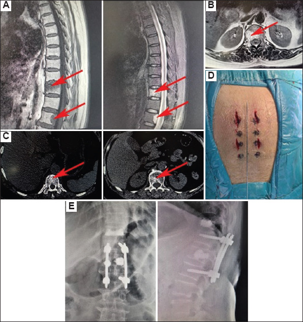 Percutaneous pedicle screw fixation combined with percutaneous vertebroplasty for the treatment of thoracic and lumbar metastatic tumors.