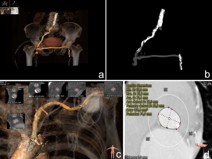 Left Axillary Access for Transcatheter Aortic Valve Implantation in a Patient With Two Dependent Internal Mammary Artery Grafts and a Permanent Left-Sided Implanted Pacemaker.