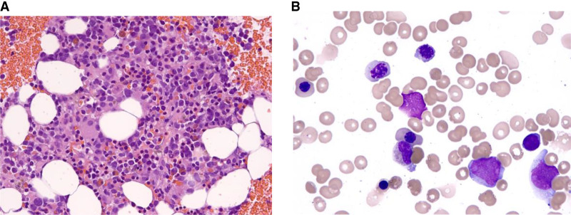 A familial <i>SAMD9</i> variant present in pediatric myelodysplastic syndrome.