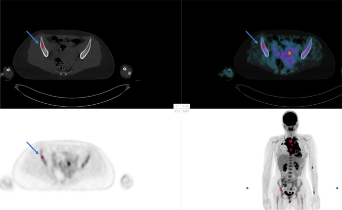 Artificial Intelligence Increases the Agreement among Physicians Classifying Focal Skeleton/Bone Marrow Uptake in Hodgkin's Lymphoma Patients Staged with [<sup>18</sup>F]FDG PET/CT-a Retrospective Study.