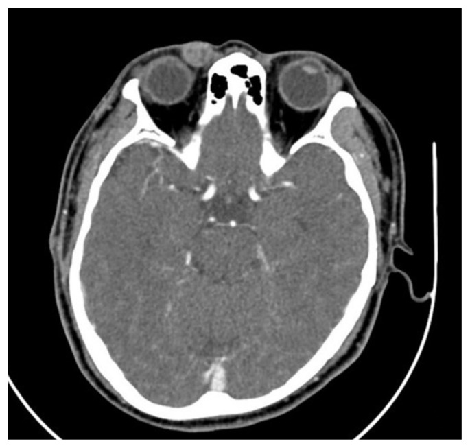 Periorbital cutaneous angiomyolipoma: a case report.