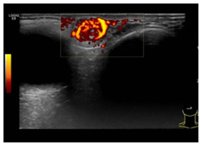 Periorbital cutaneous angiomyolipoma: a case report.