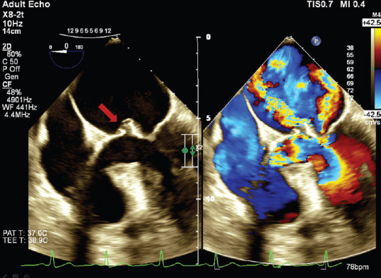 A Case of Perforated Infected Aneurysm of Mitral Valve Initially Misdiagnosed as a Tumoral Lesion.