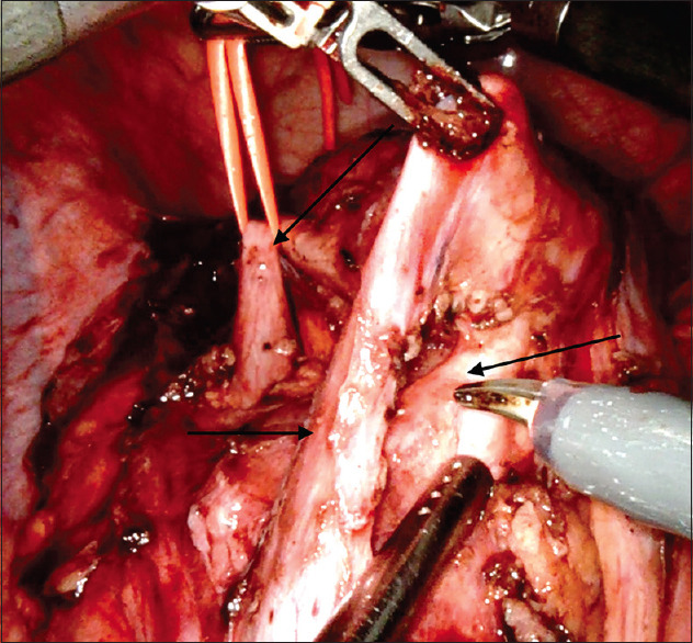 Extrarenal calyces in a pelvic kidney with ureteropelvic junction obstruction in an adult male - A rare case report.