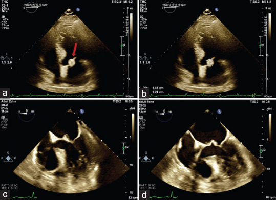 A Case of Perforated Infected Aneurysm of Mitral Valve Initially Misdiagnosed as a Tumoral Lesion.