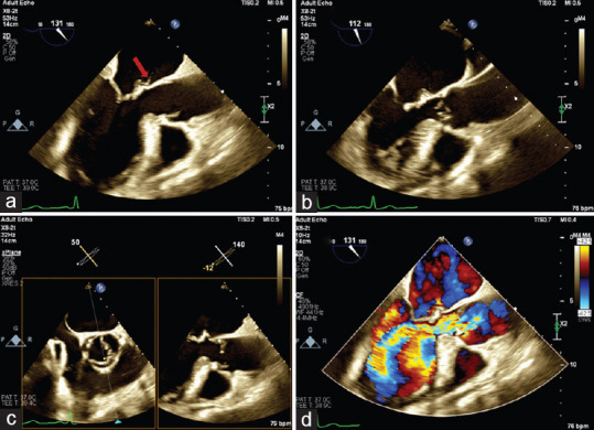 A Case of Perforated Infected Aneurysm of Mitral Valve Initially Misdiagnosed as a Tumoral Lesion.