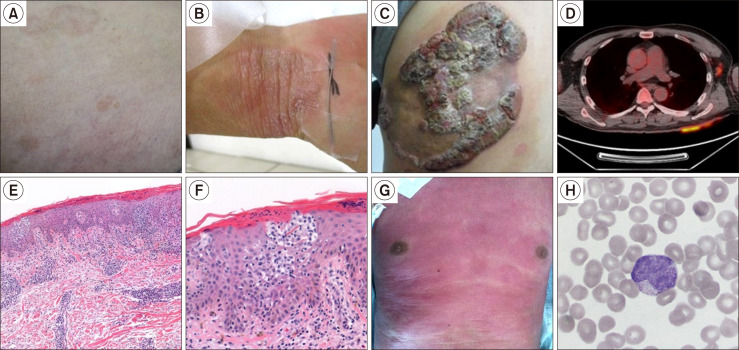 Mycosis fungoides and Sézary syndrome.