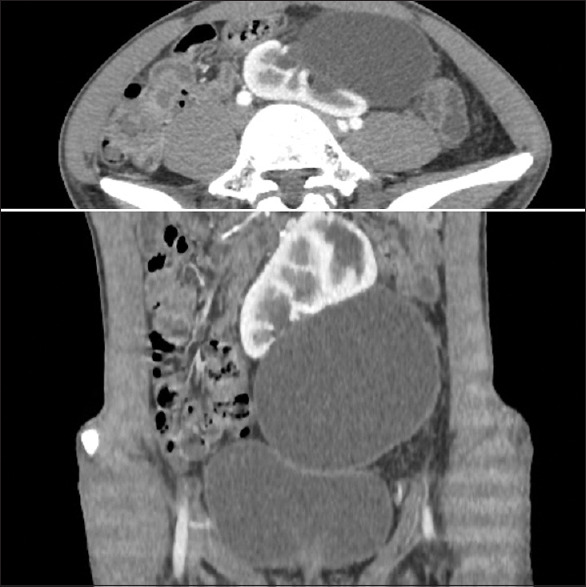 Extrarenal calyces in a pelvic kidney with ureteropelvic junction obstruction in an adult male - A rare case report.