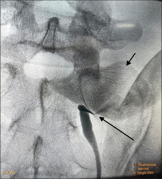 Extrarenal calyces in a pelvic kidney with ureteropelvic junction obstruction in an adult male - A rare case report.