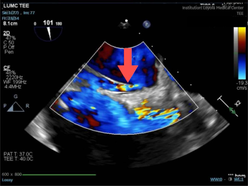 Unrecognized Patent Foramen Ovale in Patient With Sinus Venosus-Type Atrial Septal Defect With Partial Anomalous Pulmonary Venous Return.