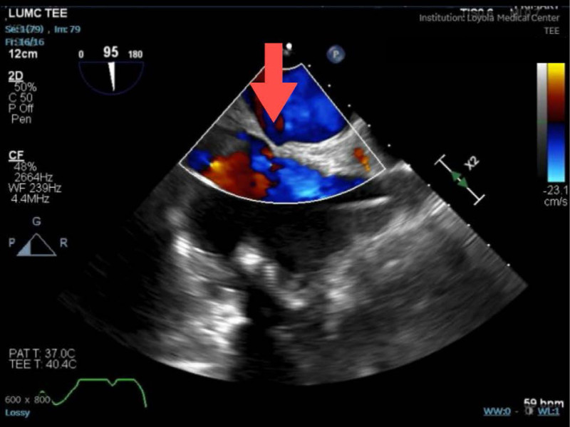 Unrecognized Patent Foramen Ovale in Patient With Sinus Venosus-Type Atrial Septal Defect With Partial Anomalous Pulmonary Venous Return.