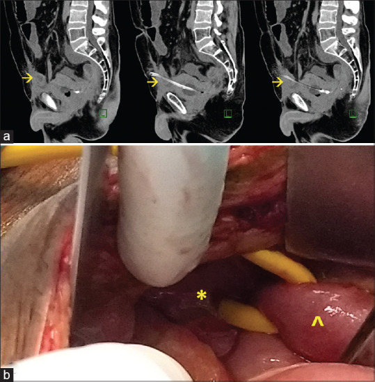 Early and late complications of suprapubic cystostomy - Report of two cases.