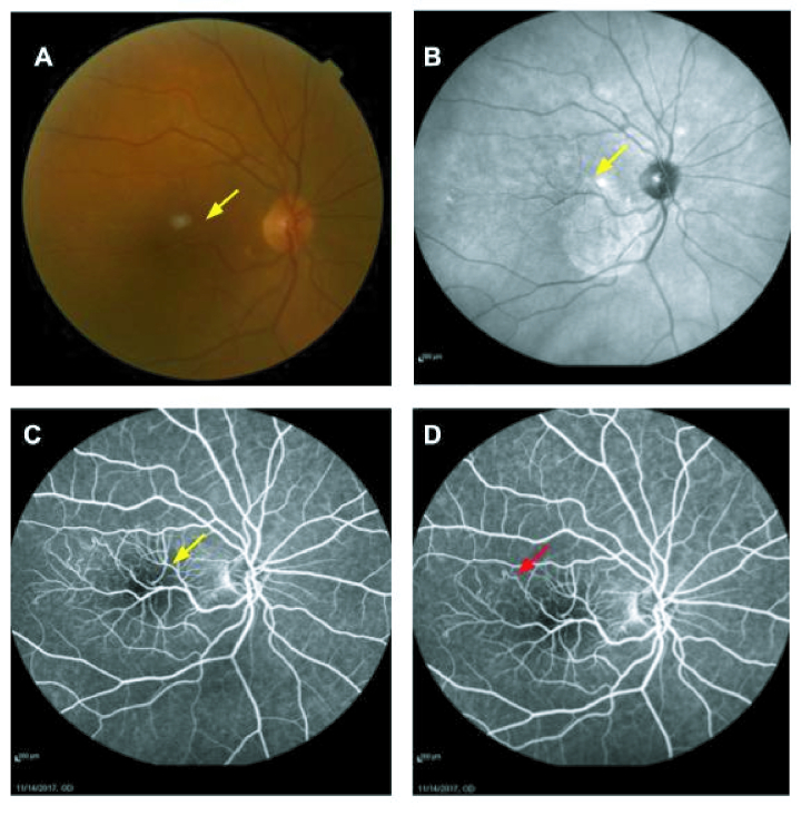 Congenital Retinal Macrovessel; Optical Coherence Tomography Angiography Features.