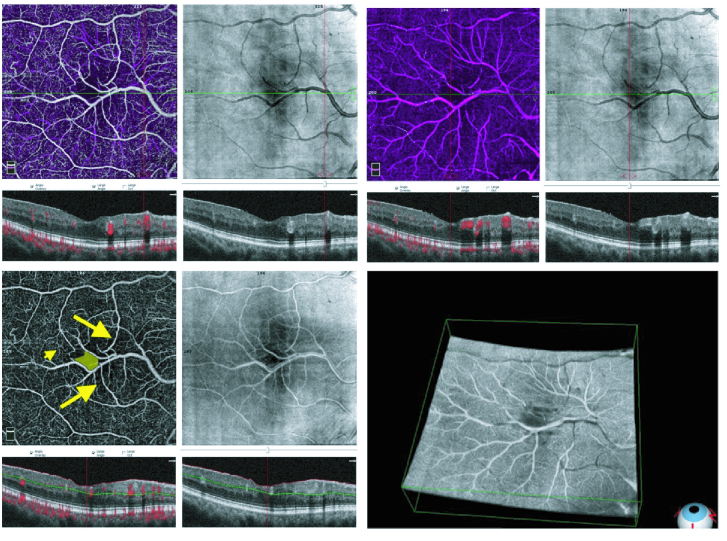 Congenital Retinal Macrovessel; Optical Coherence Tomography Angiography Features.