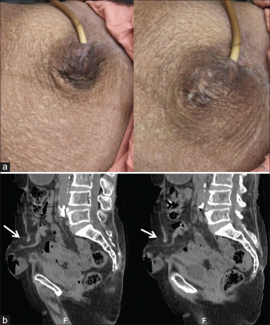 Early and late complications of suprapubic cystostomy - Report of two cases.