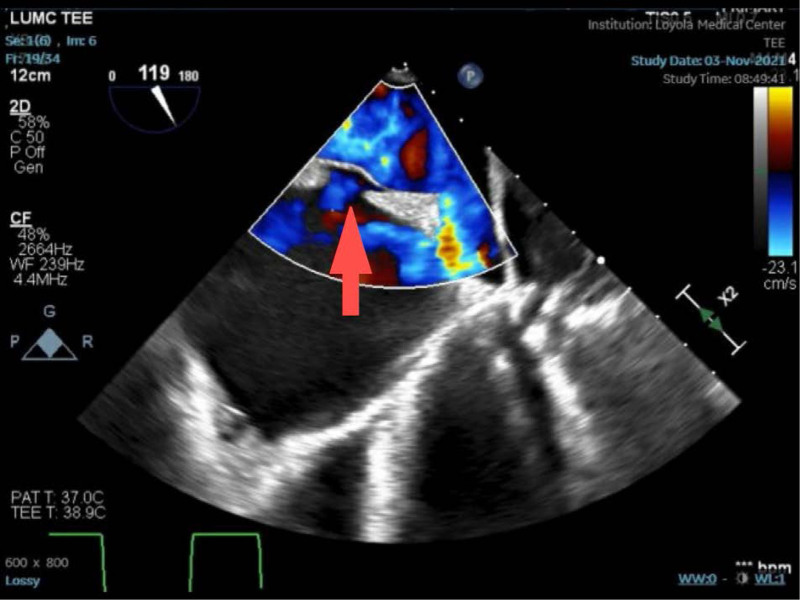 Unrecognized Patent Foramen Ovale in Patient With Sinus Venosus-Type Atrial Septal Defect With Partial Anomalous Pulmonary Venous Return.