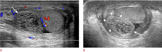 Ultrasonography of intrascrotal torsed appendages: size and interval between symptom onset and the ultrasonographic examination according to echogenicity.