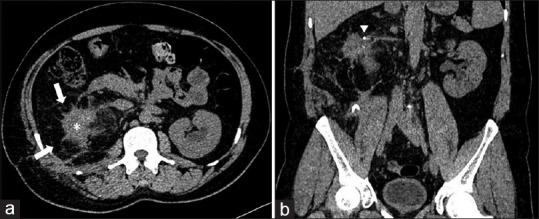 A rare diagnosis of renal replacement lipomatosis.