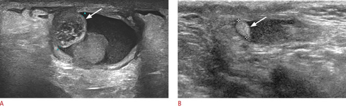 Ultrasonography of intrascrotal torsed appendages: size and interval between symptom onset and the ultrasonographic examination according to echogenicity.