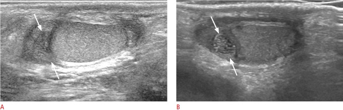 Ultrasonography of intrascrotal torsed appendages: size and interval between symptom onset and the ultrasonographic examination according to echogenicity.