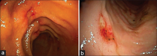 Tuberculous enteritis-induced small intestinal bleeding in a kidney transplant recipient.