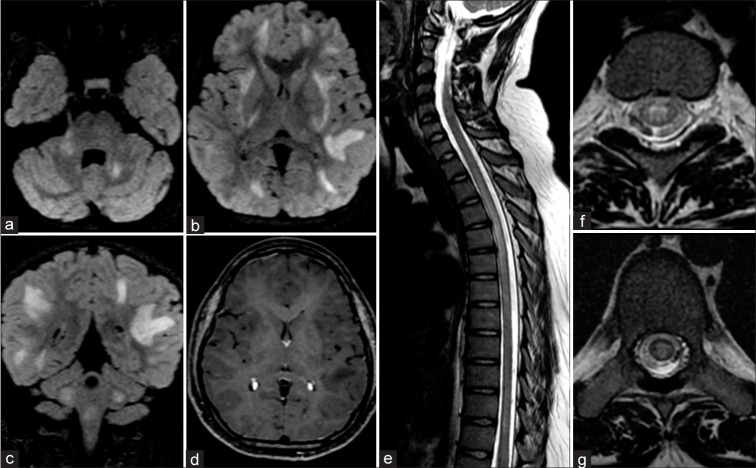 A comparative analysis of demographic, clinical and imaging features of myelin oligodendrocyte glycoprotein antibody positive, aquaporin 4 antibody positive, and double seronegative demyelinating disorders - An Indian tertiary care center prospective study.