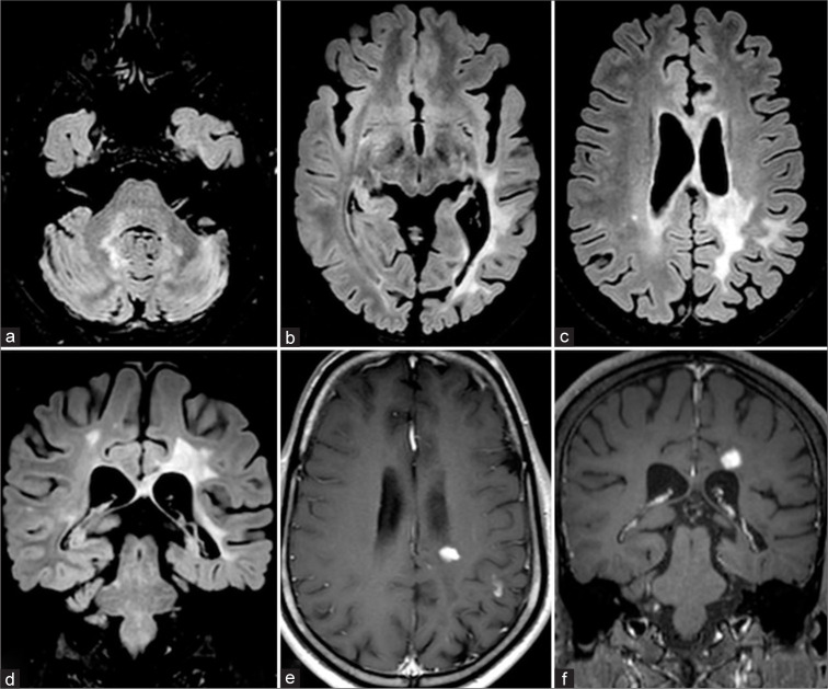 A comparative analysis of demographic, clinical and imaging features of myelin oligodendrocyte glycoprotein antibody positive, aquaporin 4 antibody positive, and double seronegative demyelinating disorders - An Indian tertiary care center prospective study.