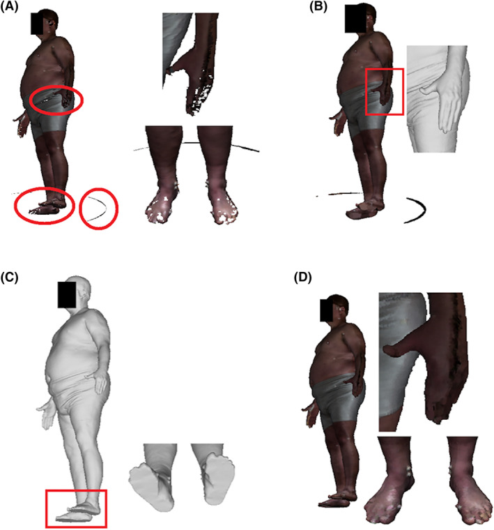 Modification and refinement of three-dimensional reconstruction to estimate body volume from a simulated single-camera image.