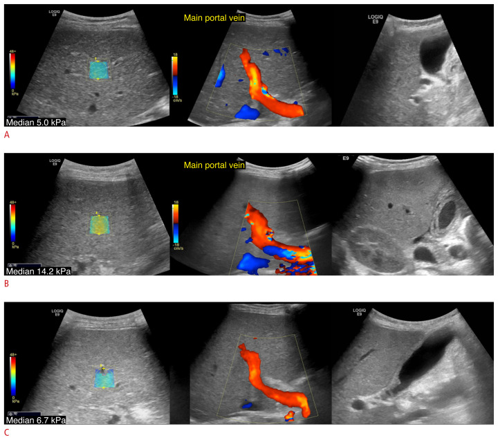 Usefulness of two-dimensional shear wave elastography in diagnosing hepatic veno-occlusive disease in pediatric patients undergoing hematopoietic stem cell transplantation.