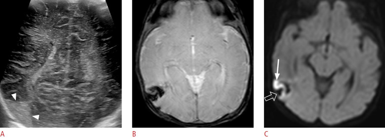 Ultrasound findings of subpial hemorrhage in neonates.