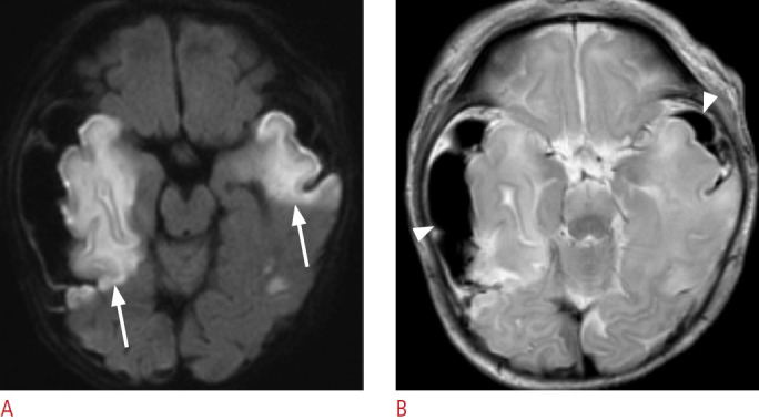 Ultrasound findings of subpial hemorrhage in neonates.