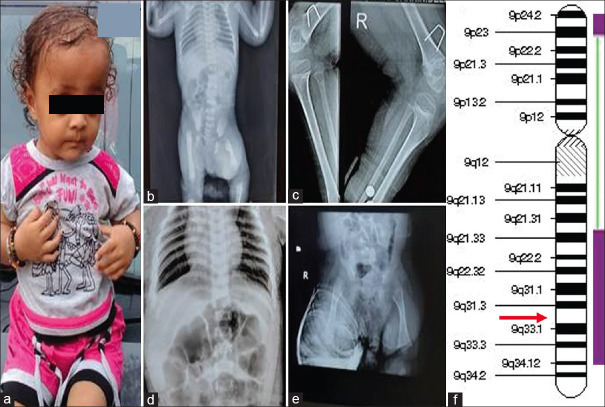 Regions of homozygosity and a novel variant in Steel syndrome: An added dilemma to diagnosis.