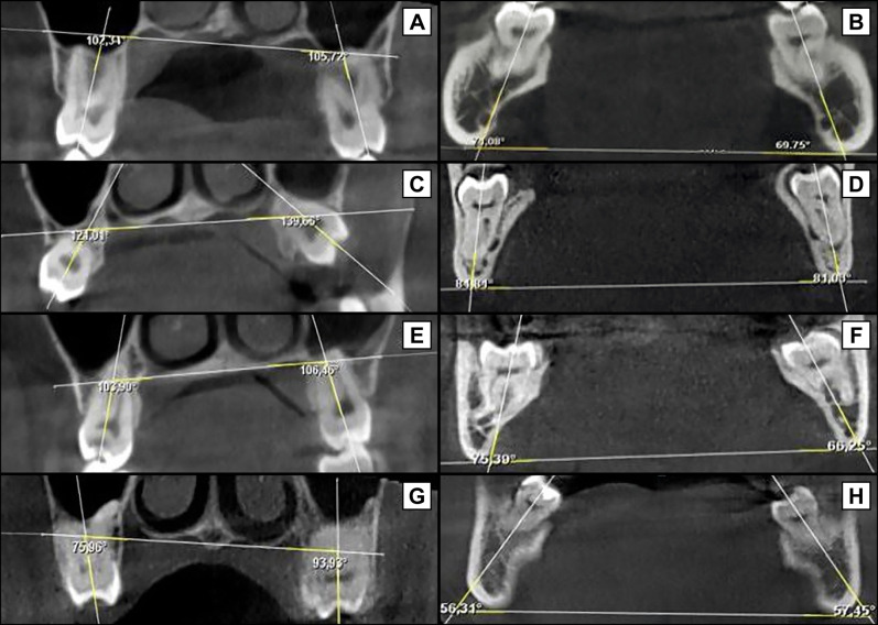 Can the Position of the Impacted Third Molars Be an Early Risk Indicator of Pathological Conditions? A Retrospective Cone-Beam Computed Tomography Study.