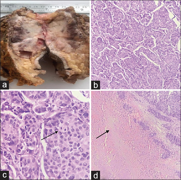 Primary cutaneous neuroendocrine tumor with axillary lymph node metastasis: A clinical masquerade.