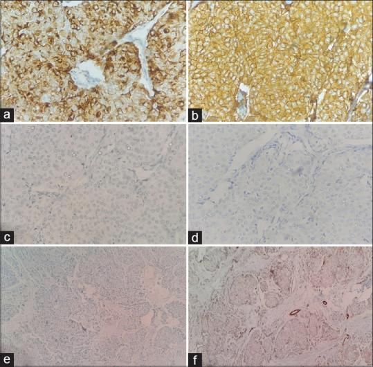 Primary cutaneous neuroendocrine tumor with axillary lymph node metastasis: A clinical masquerade.