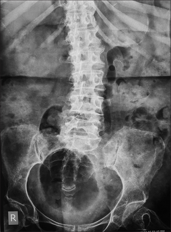 A rare case of air cysto-uretero-pyelogram due to emphysematous cystitis.